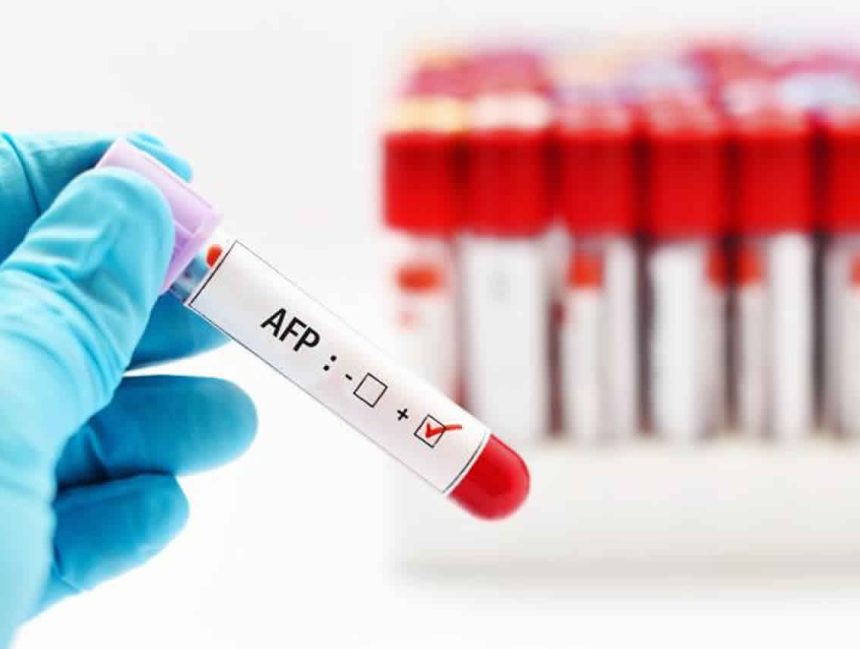 AFP Testi (Alfa FetoProtein) Nedir?