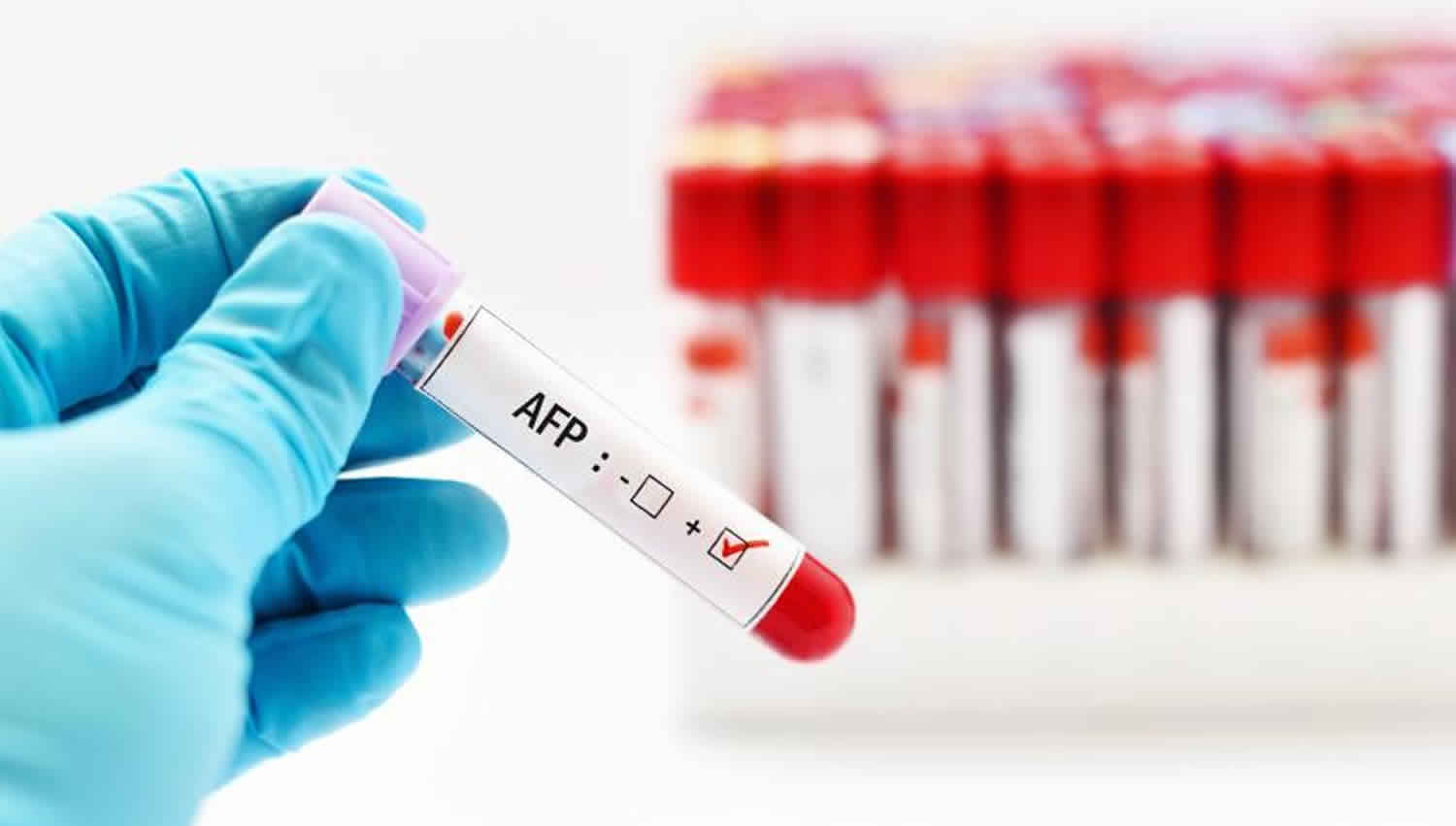 AFP Testi (Alfa FetoProtein) Nedir?