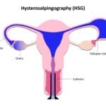 Hysterosalpingography