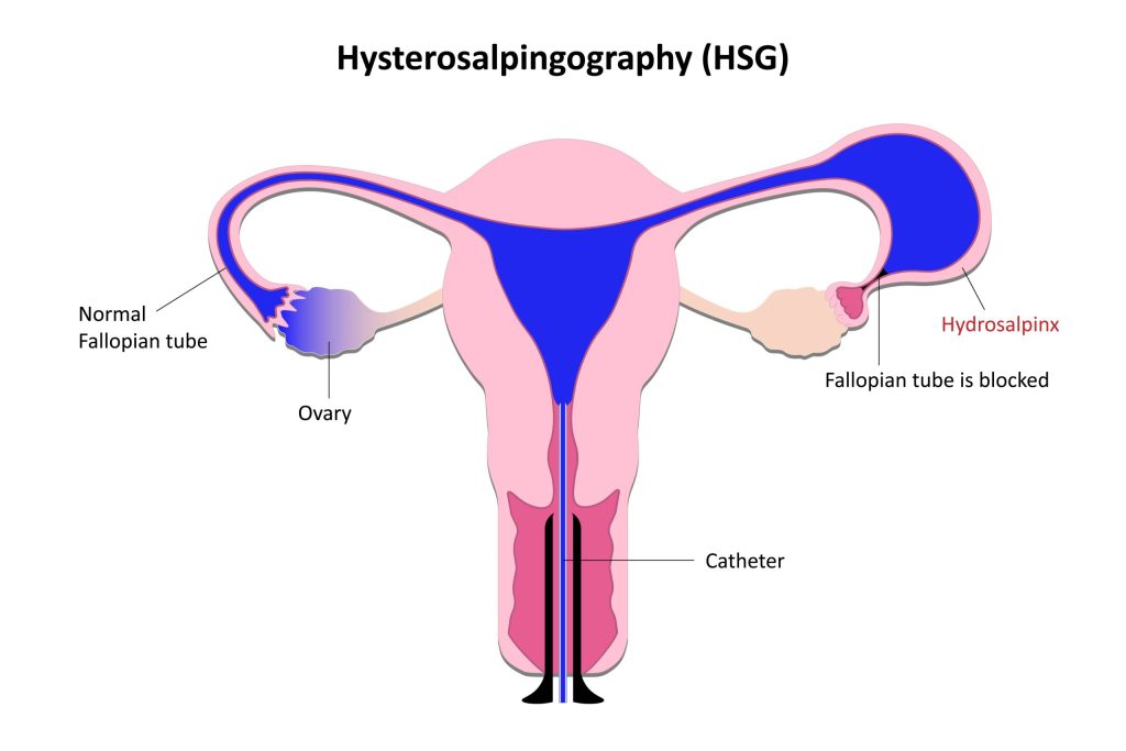 Hysterosalpingography