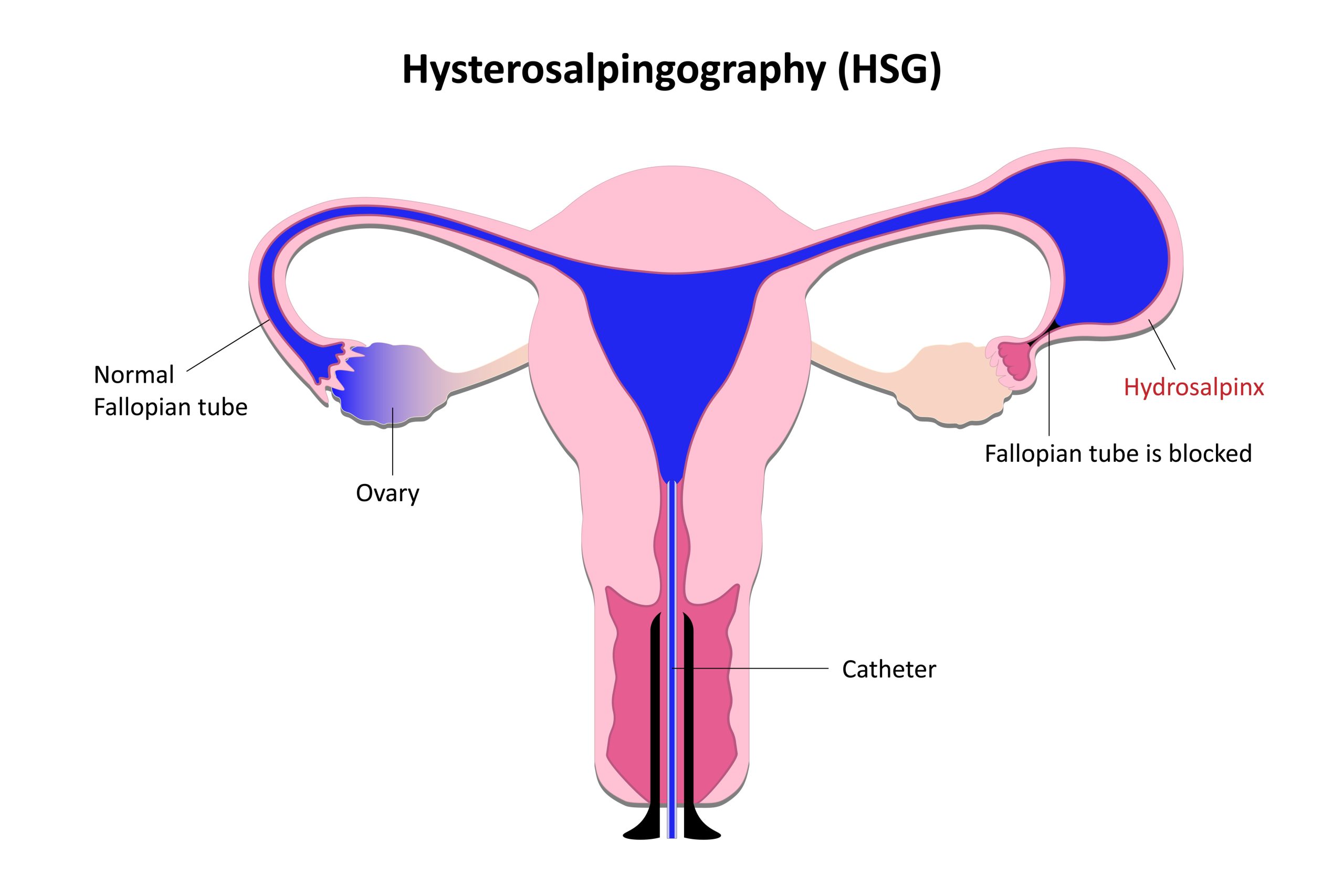 What is Hysterosalpingography (HSG)? Why is it Performed Before IVF Treatment?