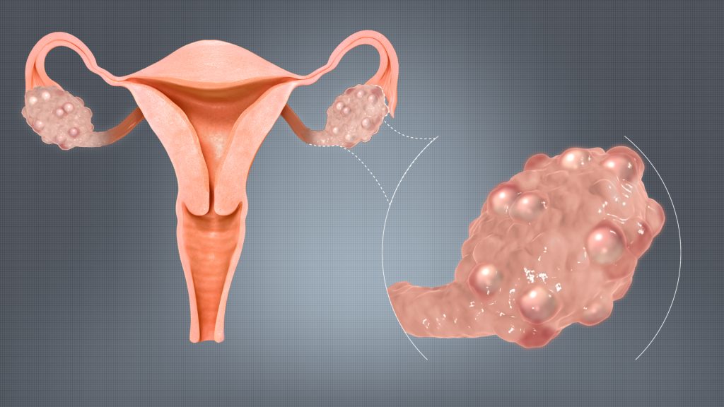 Polycystic_Ovaries