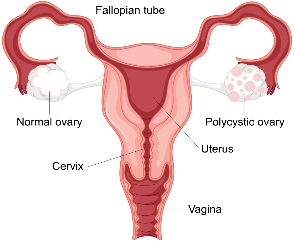 pcos