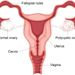pcos