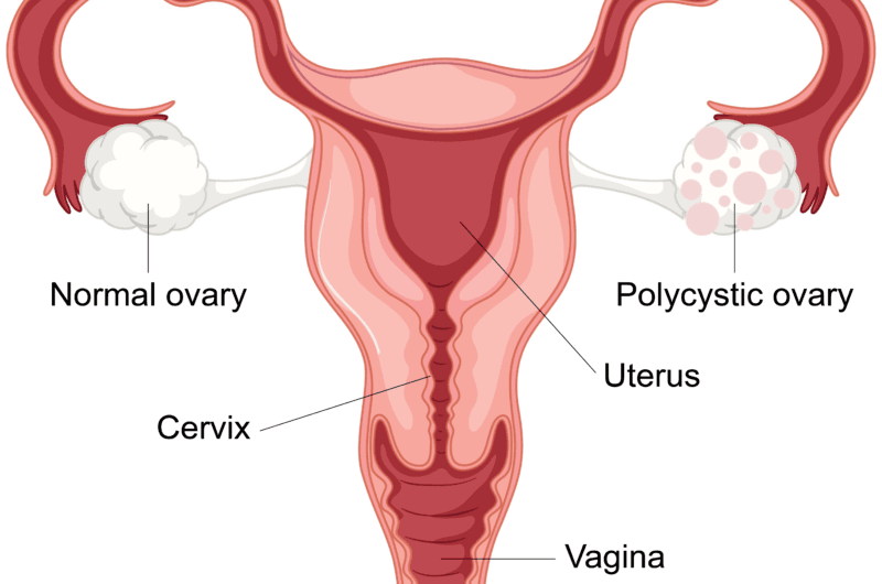What is Polycystic Ovary Syndrome (PCOS)? How is it Treated?