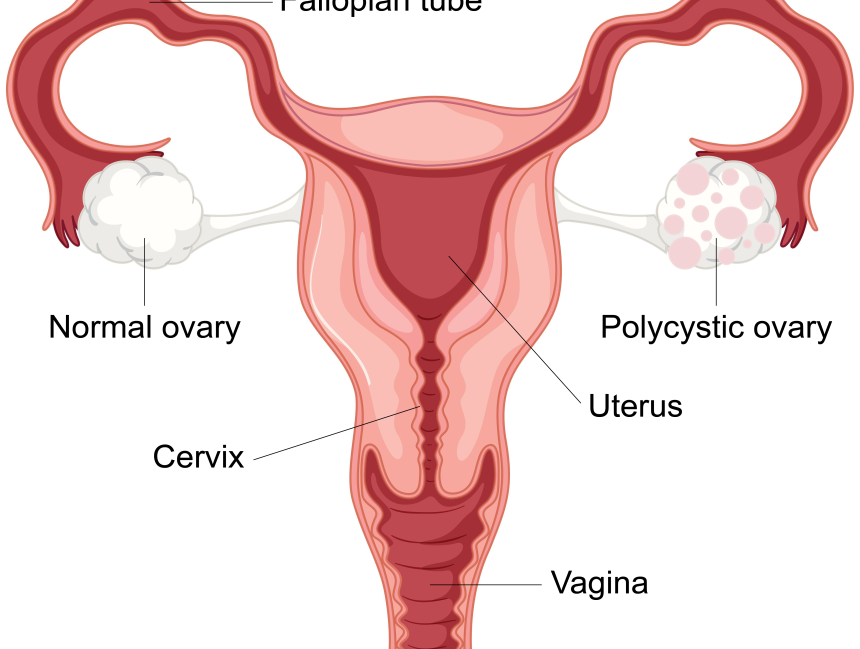 What is Polycystic Ovary Syndrome (PCOS)? How is it Treated?