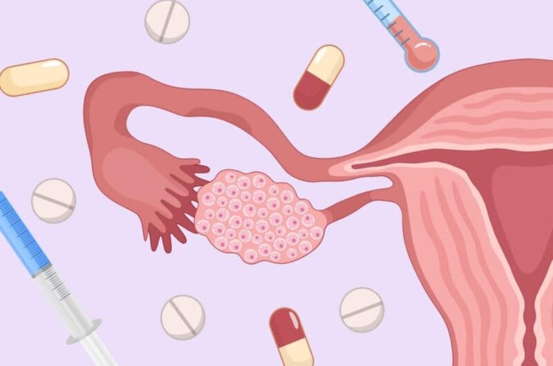 OHSS Symptoms After Egg Retrieval: What You Need to Know