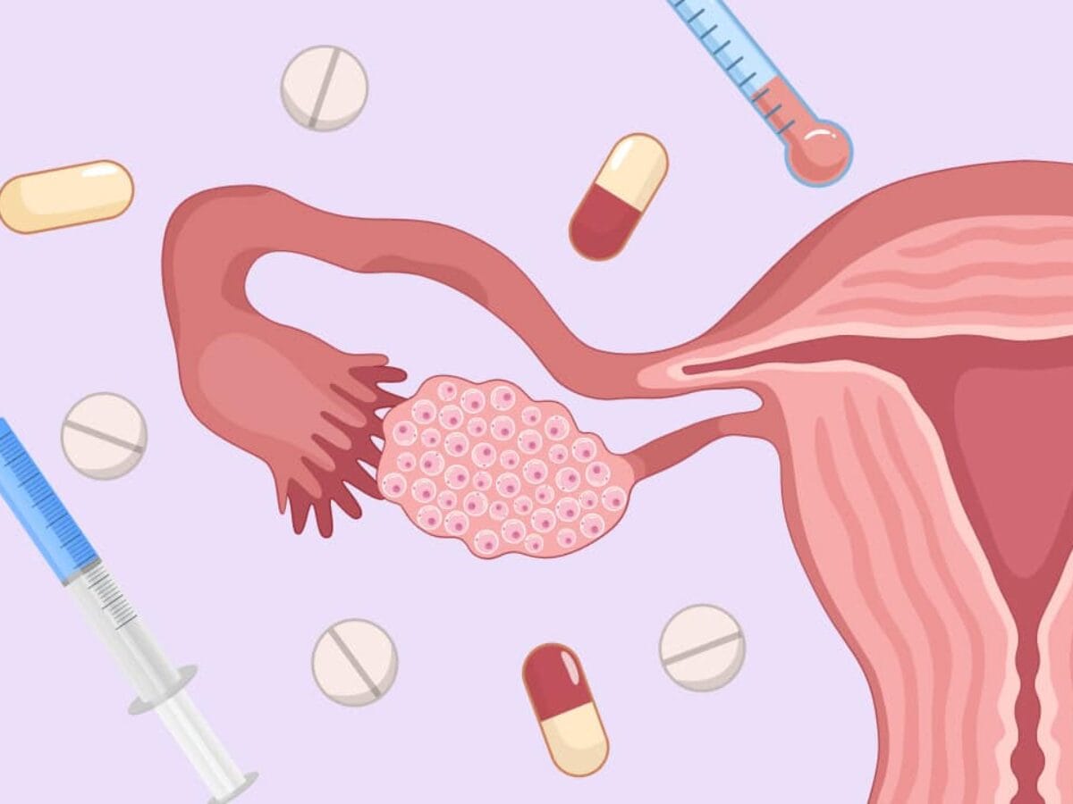 OHSS Symptoms After Egg Retrieval: What You Need to Know