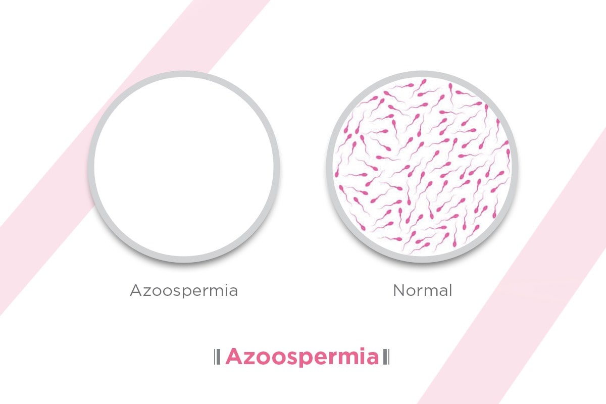 What is Azoospermia? Symptoms, Causes and Treatment