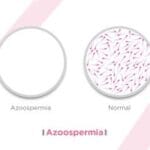 Was ist Azoospermie