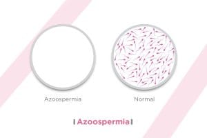 Was ist Azoospermie? Symptome, Ursachen & Behandlung