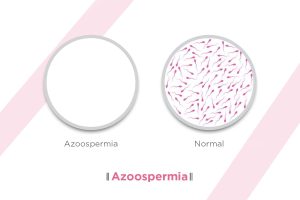 Was ist Azoospermie