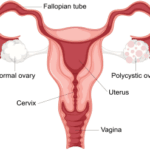 pcos