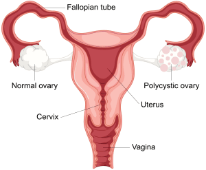 Polikistik Over Sendromu (PCOS) Nedir? Nasıl Tedavi Edilir?