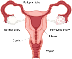 Was ist das Polyzystische Ovarialsyndrom (PCOS)? Wie wird es behandelt?